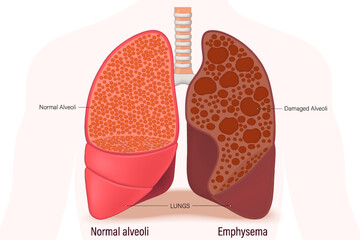 Emphysema. Comparison between normal alveoli and emphysema. Lung diseases anatomy. Human respiratory system.