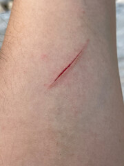 Close-up of a knife wound.