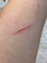 Close-up of a knife wound.