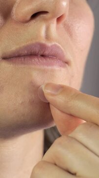 Vertical video of woman applying patches to treat acne on her face. Close up, 4k footage.