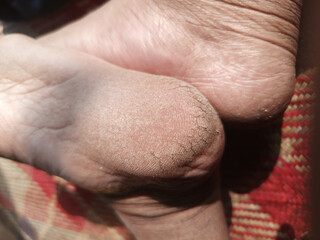 Close-up of dry, cracked heels, a sign of foot skin problems.