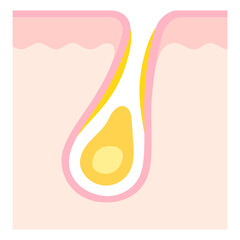 角栓の詰まった毛穴　断面図