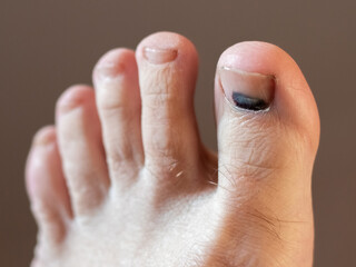 Close up of a toe with a bruise under the nail indicating a possible injury or contusion reflecting...