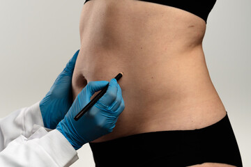 Preparing for Cosmetic Surgery with Markings on Abdomen