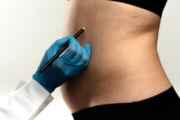 Preparing for Cosmetic Surgery with Markings on Abdomen