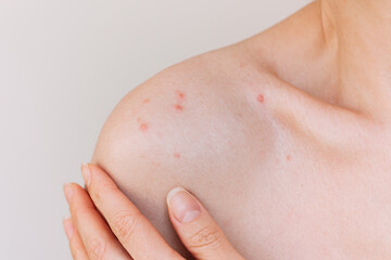 Young caucasian woman suffering acne and skin rash on her shoulder. Skin diseases. Hormonal...