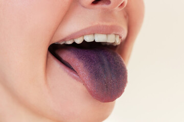 A young woman showing a stained blue tongue after eating blueberries