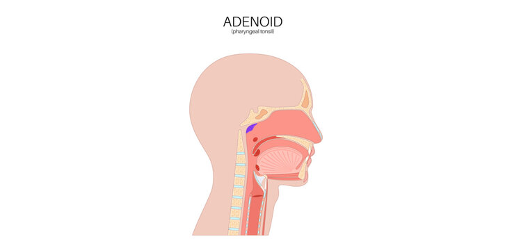 Adenoid medical poster