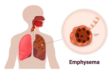 Emphysema. Damaged alveoli. Lung diseases anatomy. Human respiratory system.
