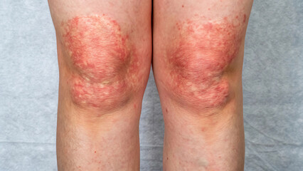 Red inflamed skin on knees psoriasis eczema dermatitis