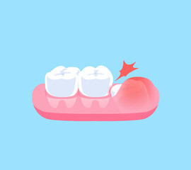 Impacted wisdom tooth illustration vector design. Dental care concept.