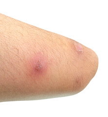 abscess or skin disease on human thigh isolated on white background with clipping path