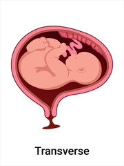 Transverse baby positions in the uterus during pregnancy. Pathology. Detailed medical vector illustration. Fetus with umbilical cord, placenta.
