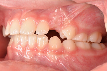 side view of a mixed dentition