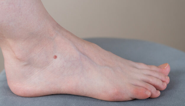 foot of a woman with a small round symmetrical birthmark (mole)