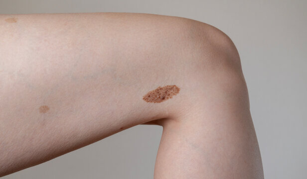 symmetrical benign convex nevus (birthmark) on a woman's leg, healthy skin conditions, congenital nevus, dermatology