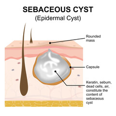 Epidermal (Sebaceous) or Skin Cyst Illustration