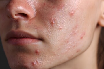Obraz premium Macro image of pimples on female skin, focusing on acne and skin issues on the cheek and jawline, ideal for illustrating skincare challenges, product before/after use, or dermatology material.