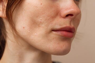 Obraz premium Skin with visible acne and blemishes, photographed in realistic tone and soft lighting, highlighting imperfections on cheek, useful for clinical references, product ads, or blog illustrations.