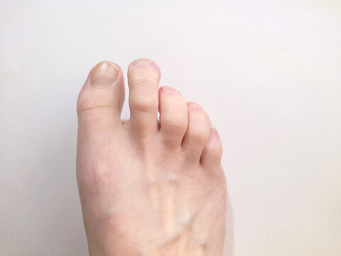 Close up of a woman's bare foot with claw toes.