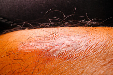 Close-up of the surface of the leg's hairy skin and burn scars. Macrophotography of leg hair and...