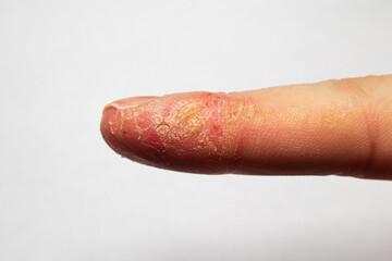 Finger of man with dermatological skin disease, looks like psoriasis. The damaged skin of the finger on the hand cracks and peels