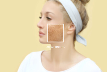 Dark spots, freckles,hyperpigmentation(melasma or chloasma),concept- skin lightening, skin whitening, Skin Brightening