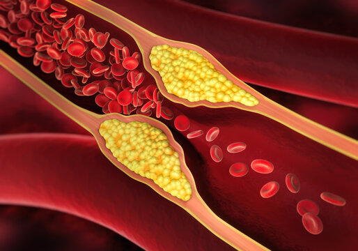 Vascular constriction
in artery - blood congestion - 3D illustration