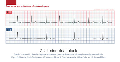 Only one of every two impulses generated by sinoatrial node can be transmitted to atrium, resulting in sinus P wave, and the other one is blocked, which is called 2:1 sinoatrial block.
