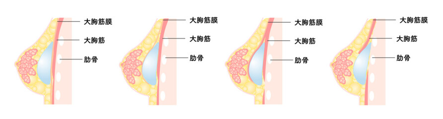 バッグ豊胸_シリーズ