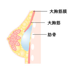 バッグ豊胸_デュアルプレーン法