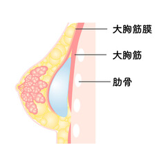 バッグ豊胸_大胸筋下法