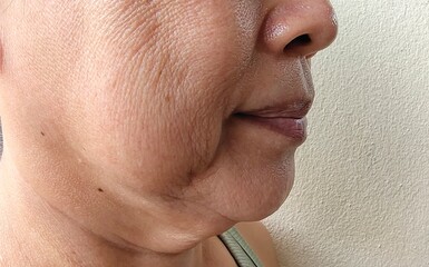 close up the flabbiness and wrinkles beside the mouth, Flabby skin and loose, dark spots and...