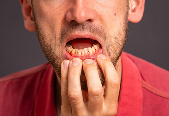 Man showing inflamed, bleeding gums as a symptom of periodontitis, poor oral hygiene and dental care