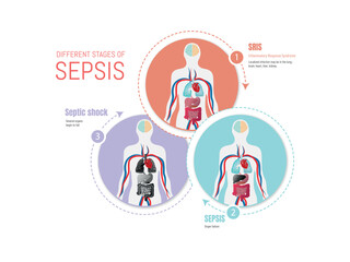 Different stages of sepsis explained with human body anatomy