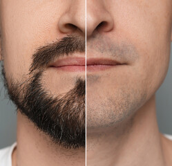 Man before and after shaving on grey background, closeup. Collage of photos