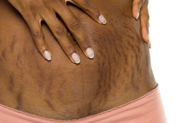 Closeup of female belly with stretch marks after pregnancy and hands on skin, studio shot on white...