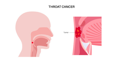 Throat cancer poster
