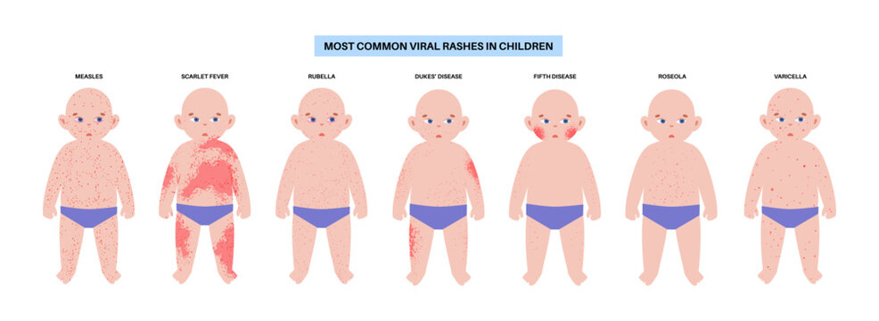 The most common viral rashes