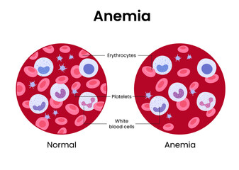 Vector illustration of the difference of number of healthy red blood cells. Anemia and normal.	
