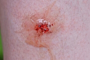 one wound with red blood on gray skin on the leg