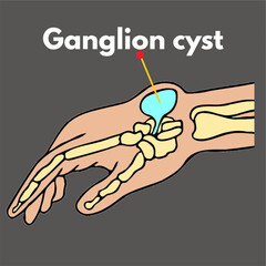 ganglion cyst on above of wrist illustration  science disease fluid filled cyst.eps