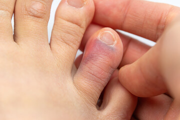 Swollen bruised toe with discoloration on light-skinned foot