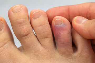 Bruised big toe on caucasian adult foot with swelling and discoloration