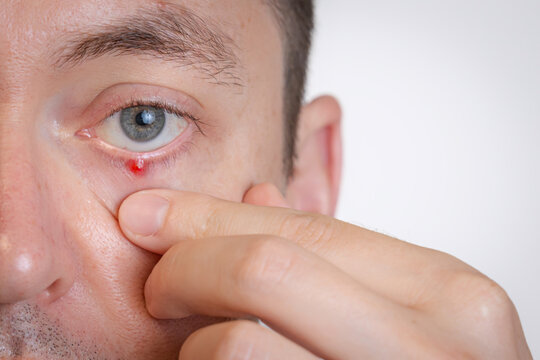 Man's eyes with pus redness like chalazion caused by blocked sebaceous glad on lower eyelid. Hordeolum. Viral infection