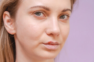 Closeup of young woman with herpes cold sore on mouth against purple background. Herpes blisters