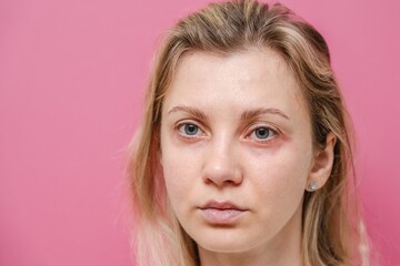 Young woman with itchy allergy or allergic sensitive reaction and red spot on her facial on pink...