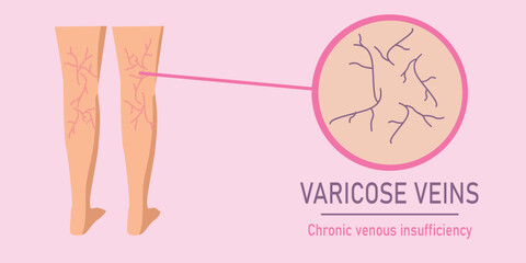 Flat vector medical illustration of varicose veins on human legs with magnified view of enlarged veins, chronic venous insufficiency concept for educational and healthcare design