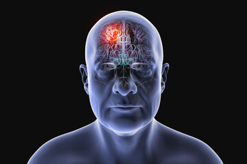 Brain tumor, 3D illustration. Meningioma, glioma, astrocytoma, and other brain tumors