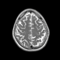Axial T2-weighted MRI of a 44-year-old patient showing normal brain structures. No visible...
